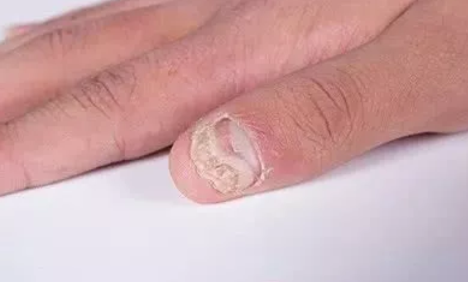 灰指甲怎么根治 v2-a078923d67e6d400c129de96c2ad5142_1440w.jpg?source=172ae18b