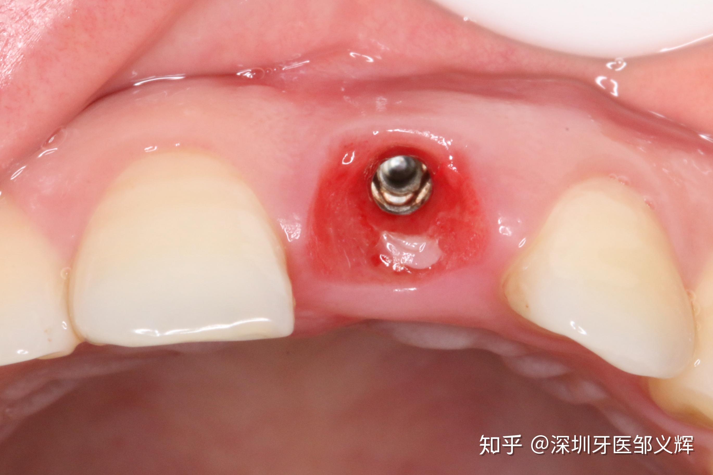 门牙外伤折断即拔即种即刻修复一例