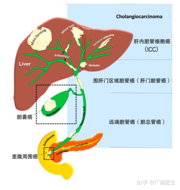 光动力可以治疗胆管癌吗？ - 知乎