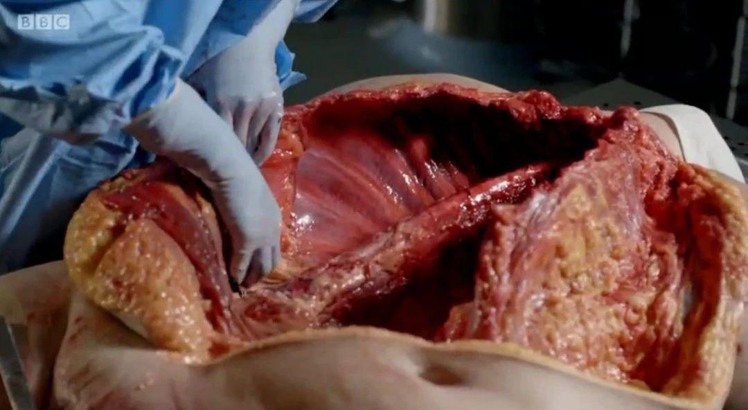 解剖脂肪纪录片图片