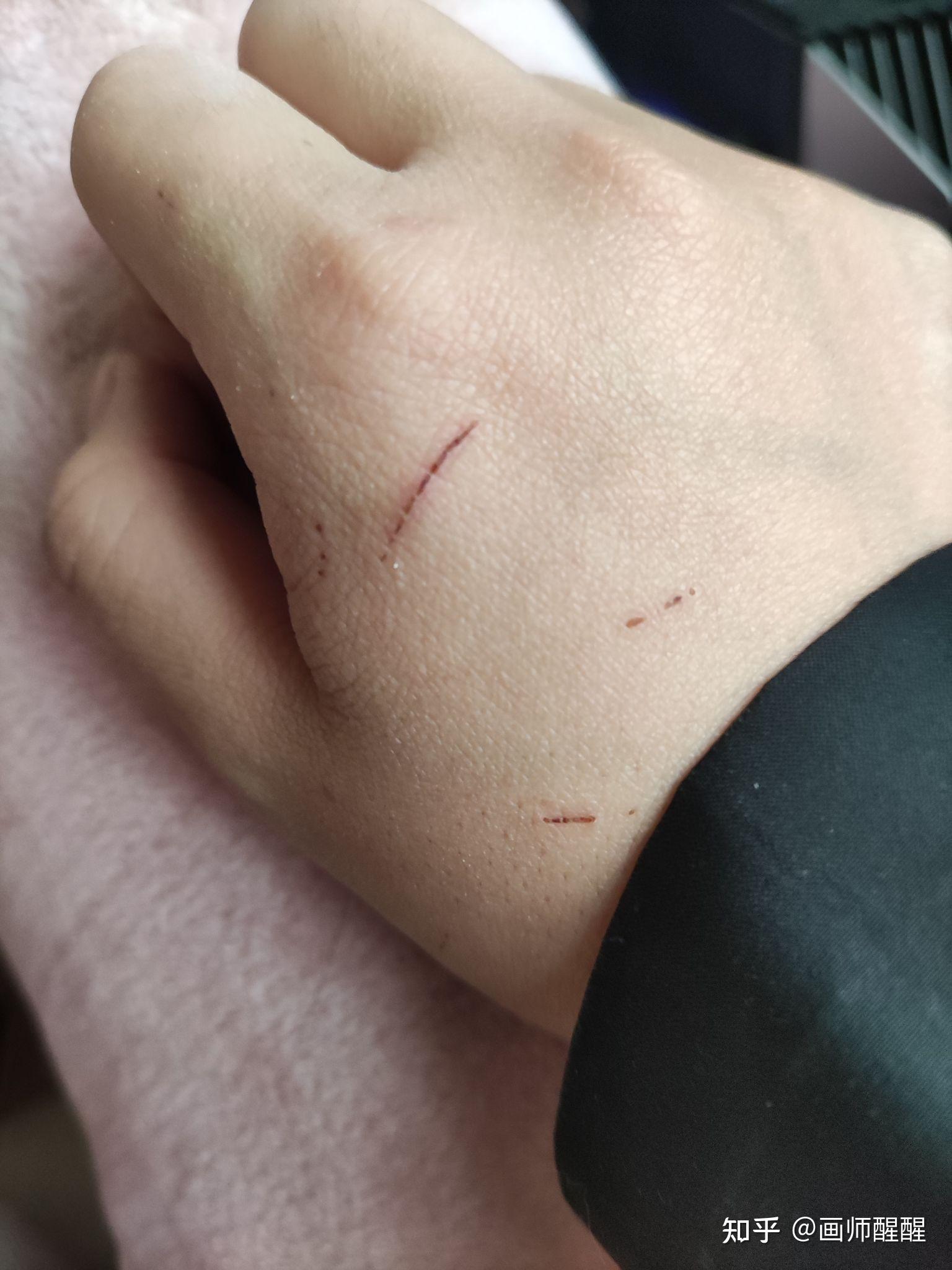 今天被自家养的兔子抓伤了需要打狂犬疫苗吗