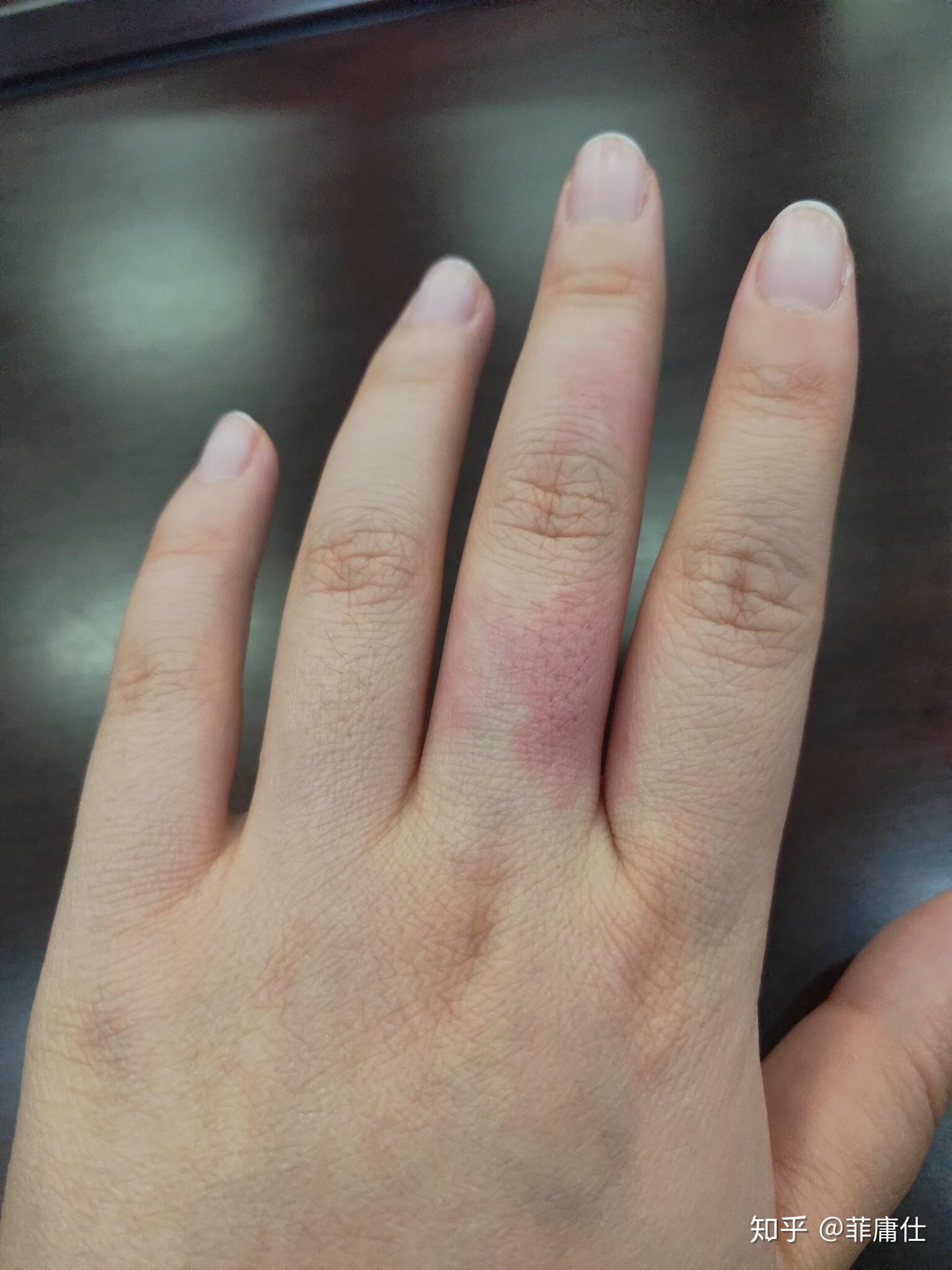 那么多年了,一直想知道有没有人胎记是在手上中指的? - 知乎