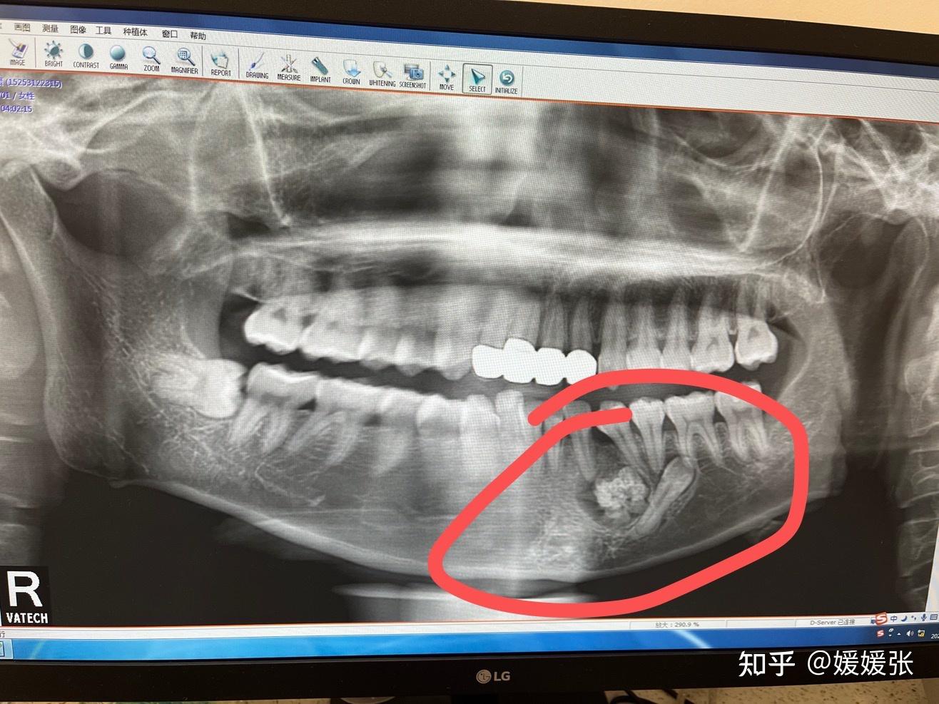 牙瘤摘除还是不摘除