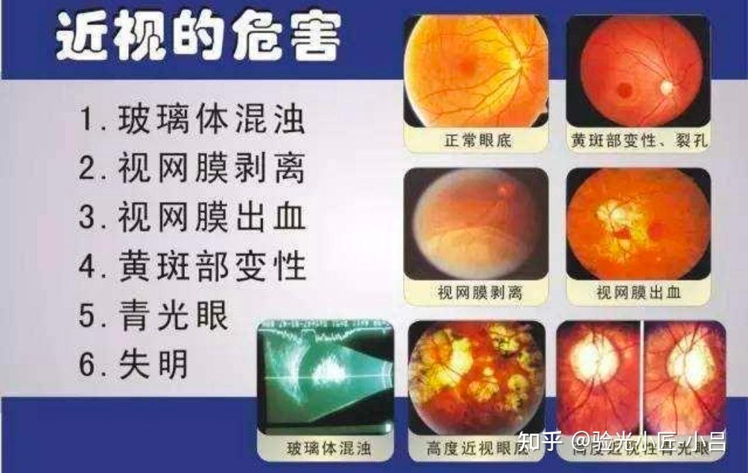 高度近视并发症