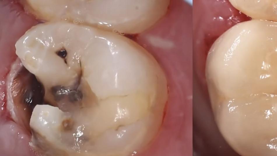 什么是根管治疗,痛不痛? - 知乎