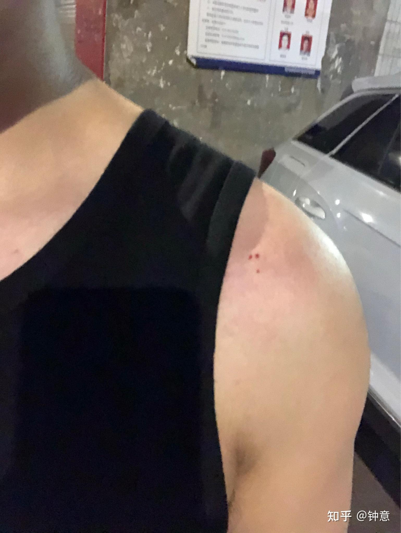 被不知道是什么的虫子咬了?