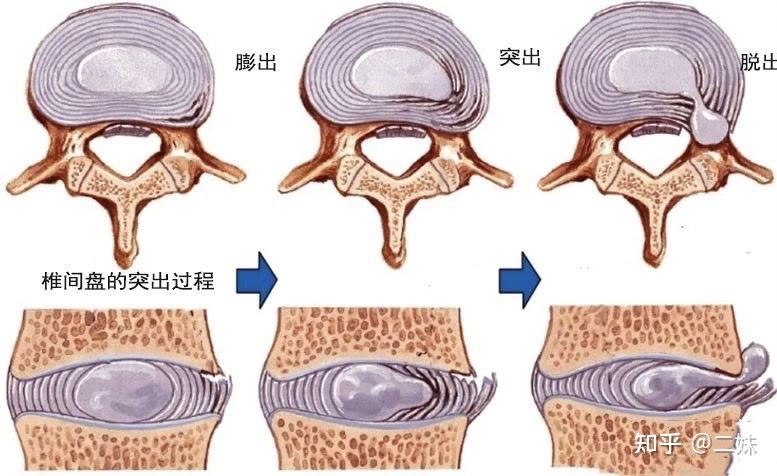 一天一點解剖學腰椎屈曲腰椎間盤突出的禁忌