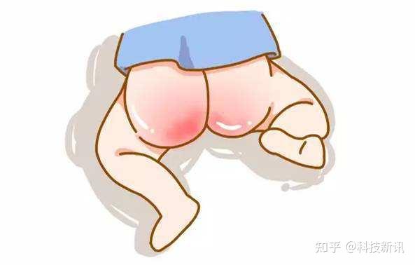 "红屁股",医学上称之为尿布皮炎,或者叫尿布疹.