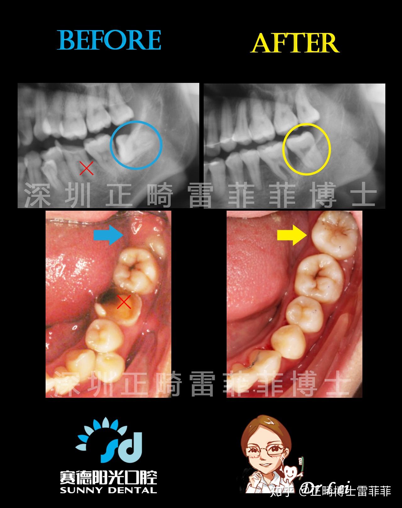智齿萌出了一点,隐适美可以做到8代7 7代6吗?