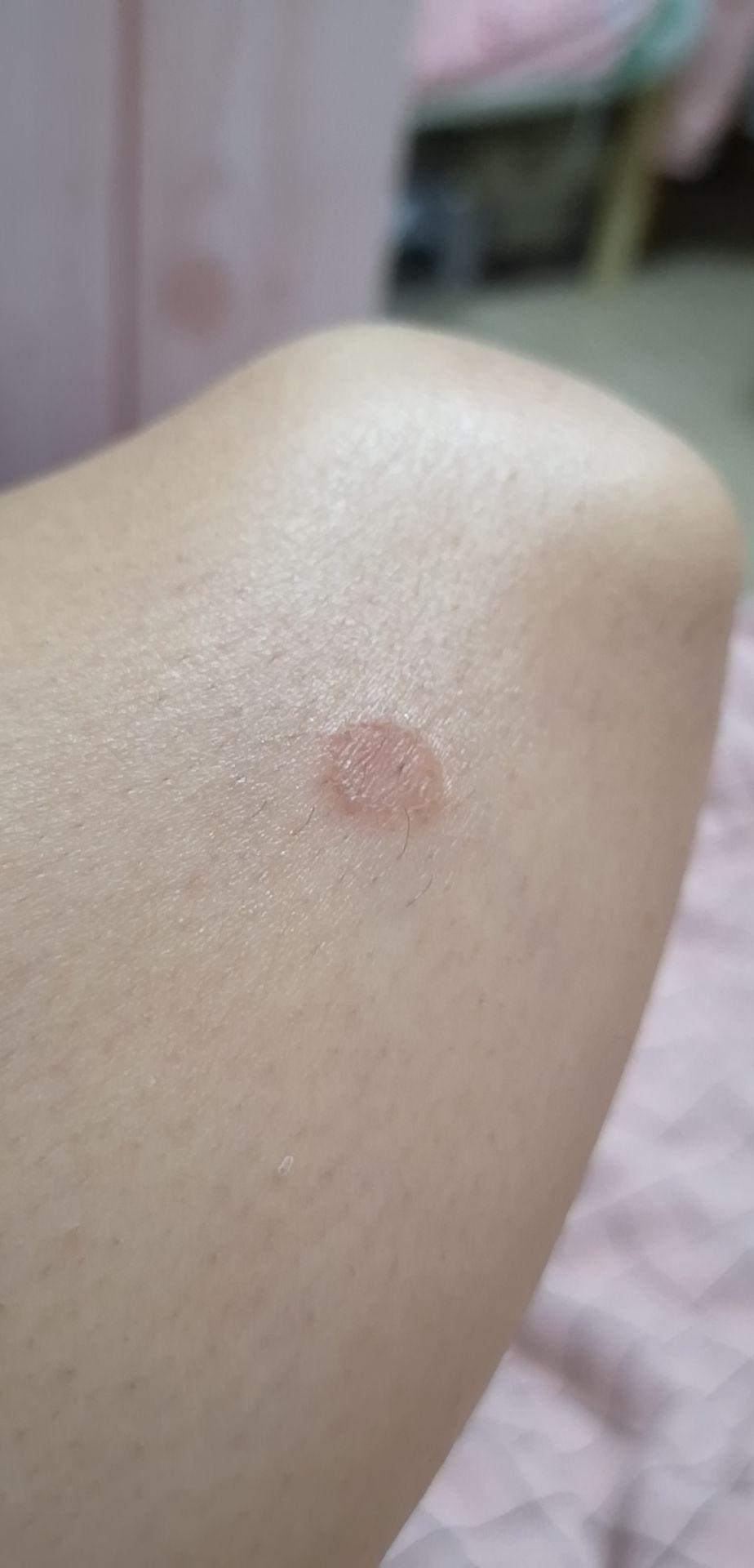 人如果得了猫癣怎么办