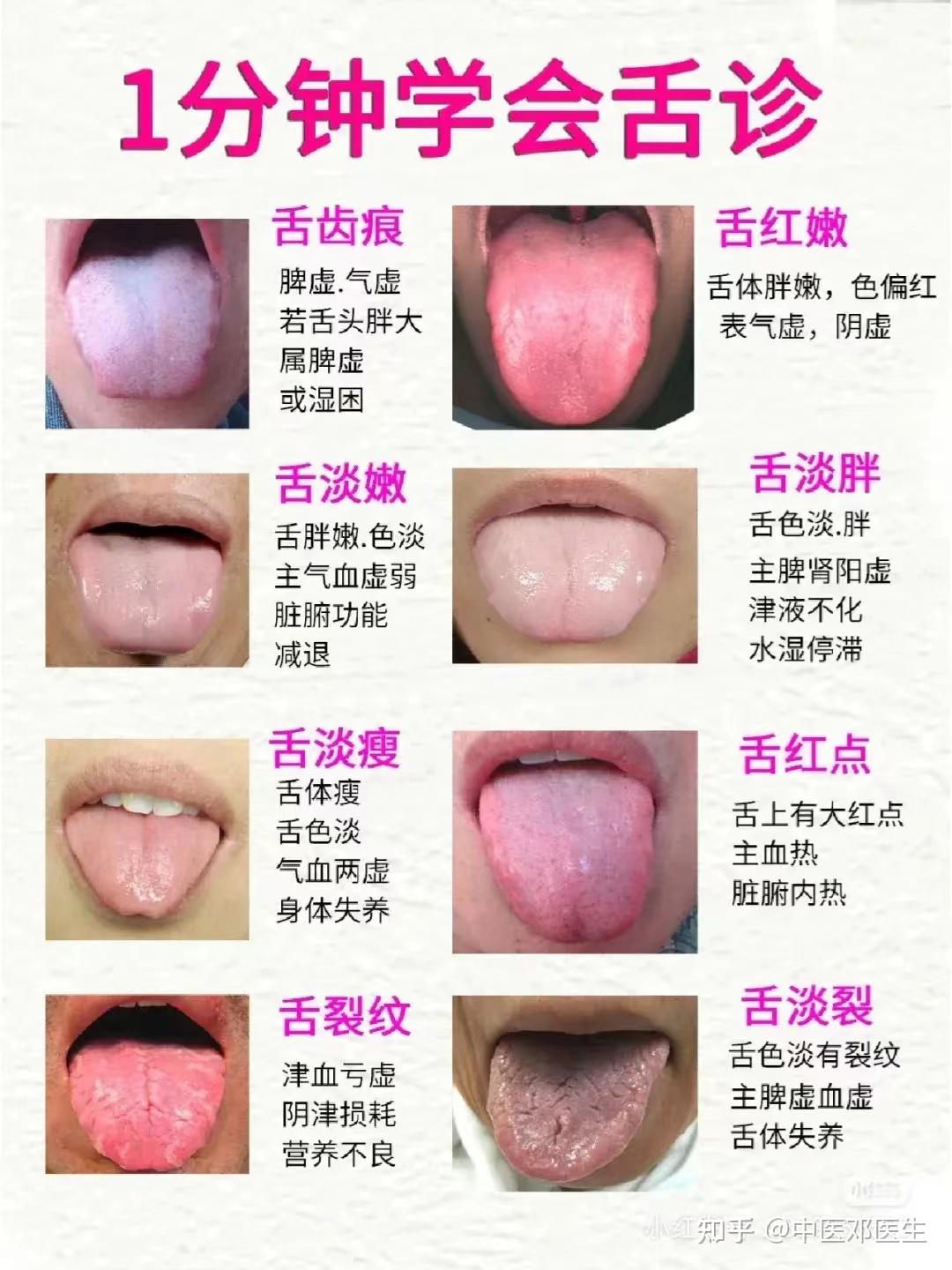 整理了一些常见的舌象，大家可以对照一下 - 知乎