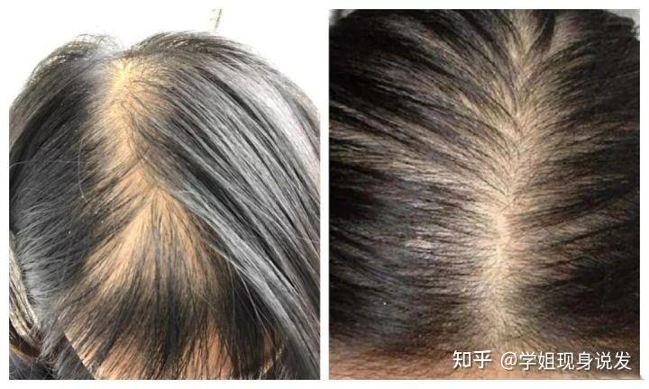 一,脂溢性脱发的表现