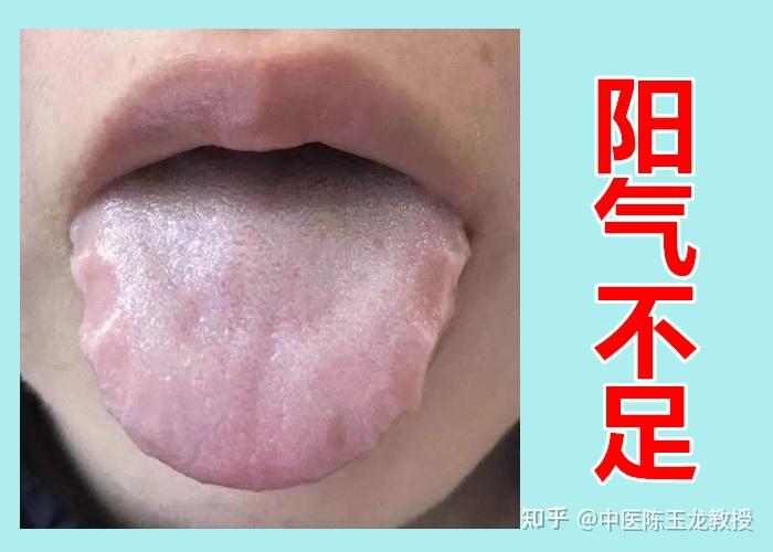 阳气不足舌先知!快来对照自己的舌头,看看自己阳虚到了哪一级? - 知乎