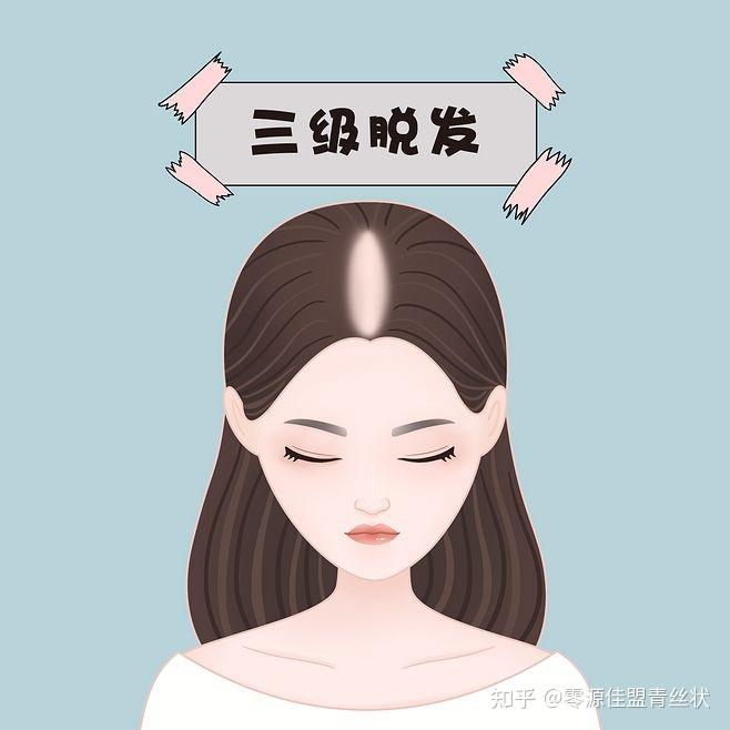 请问发旋处这发量正常不 ? - 知乎