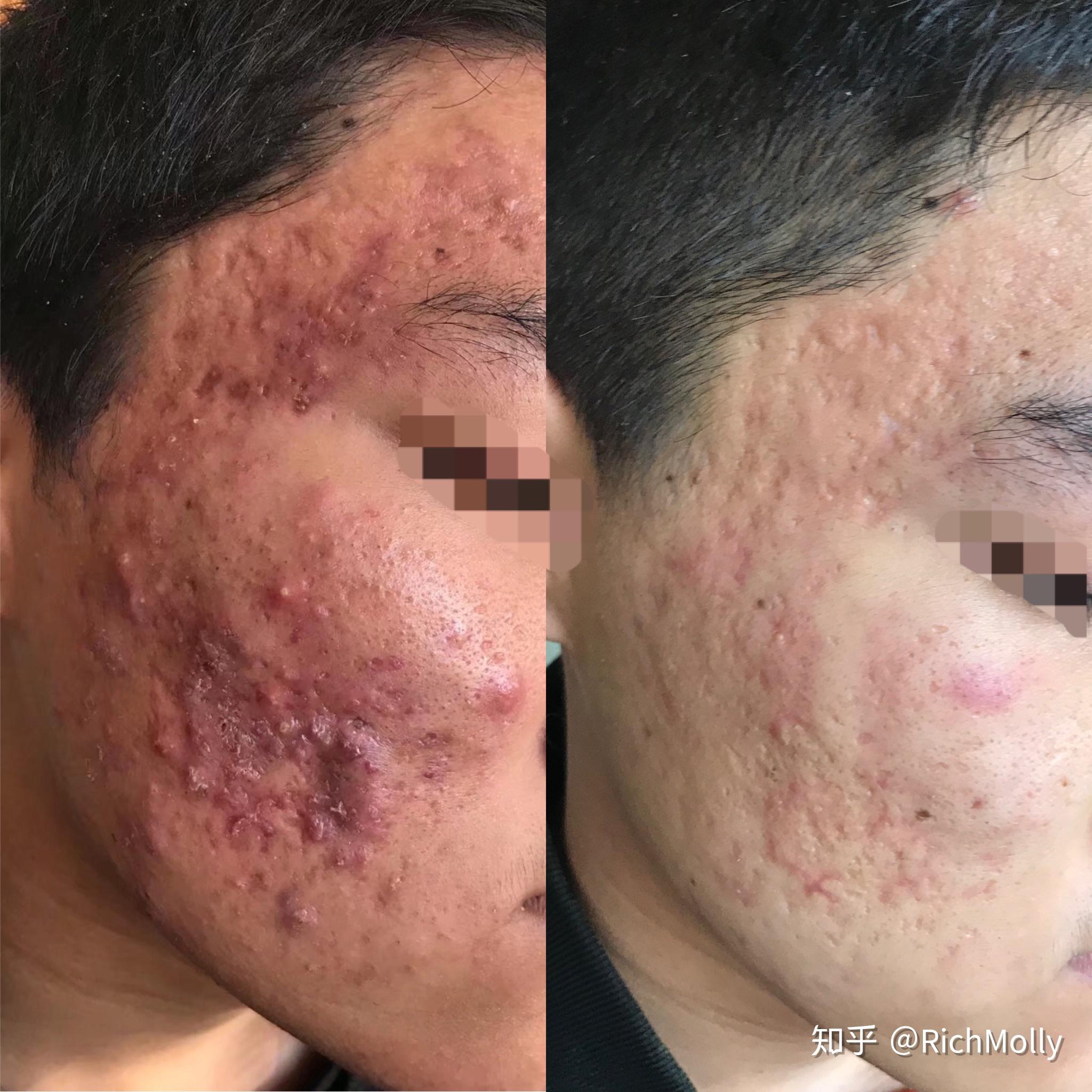 一个人痘没了颜值有多开挂