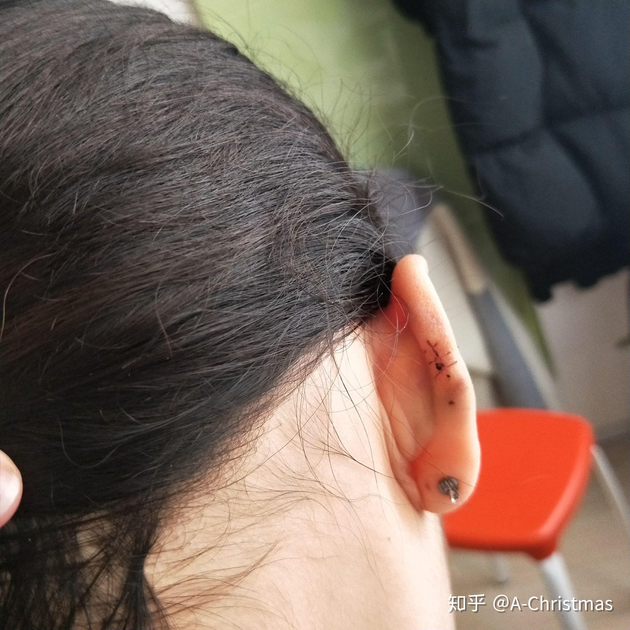 怎样解决耳朵打了耳洞后长了个肉球的糟糕状况啊,,看了那么多医生都说