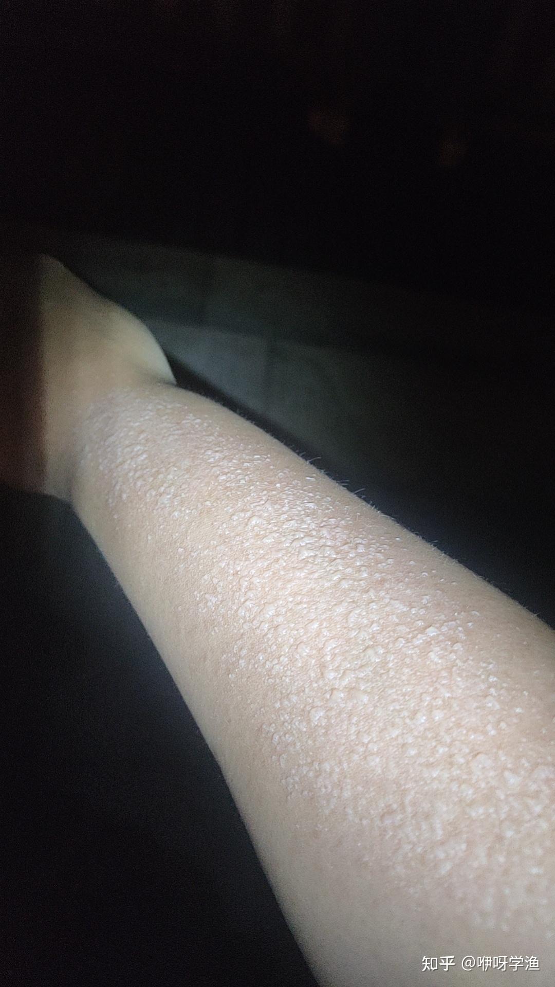 大夏天白天经常出去钓鱼,洗完澡手臂上就这样了,是什么情况?