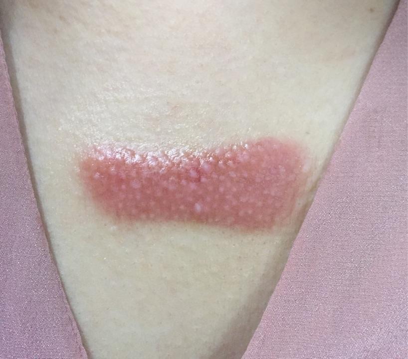 疤痕疙瘩到底怎么治?能不能治好?自己胸前长