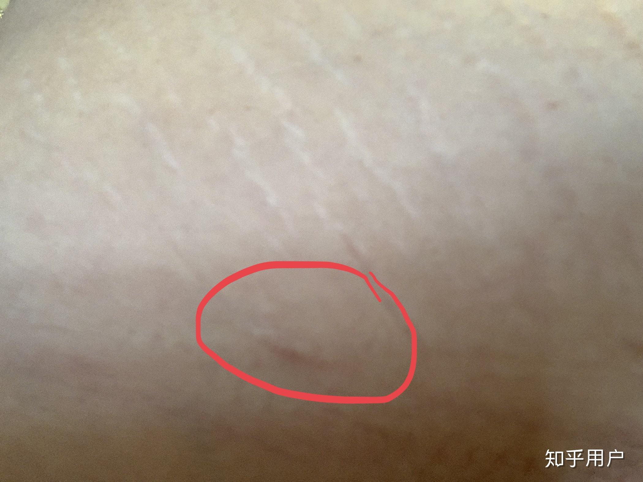 女朋友肚子左右两边和肚脐眼有手术刀口.请问是做过什么手术? - 知乎