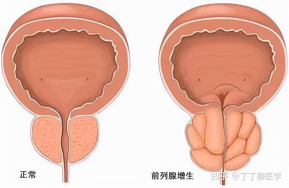 解剖學上的前列腺增大,下尿路症狀為主的臨床症狀以及尿流動力學上的