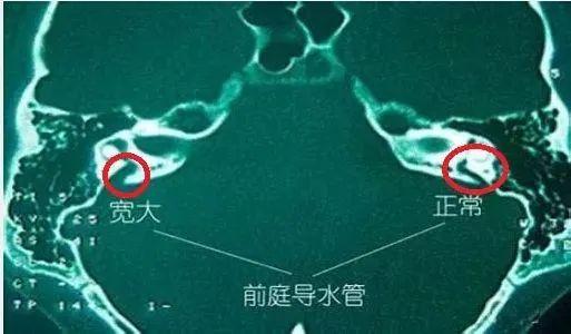 浅谈大前庭导水管综合症 - 知乎