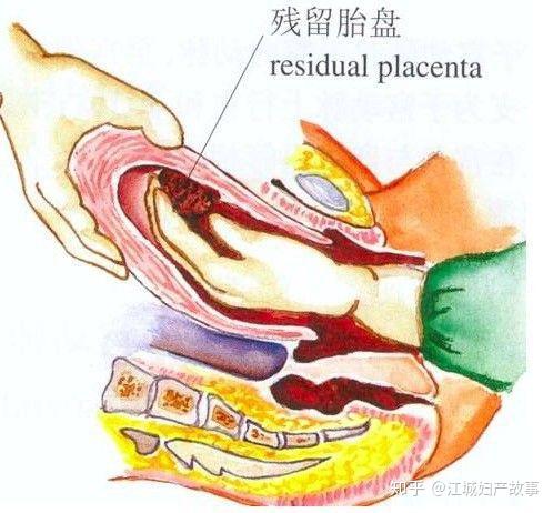 扯胎盘图片
