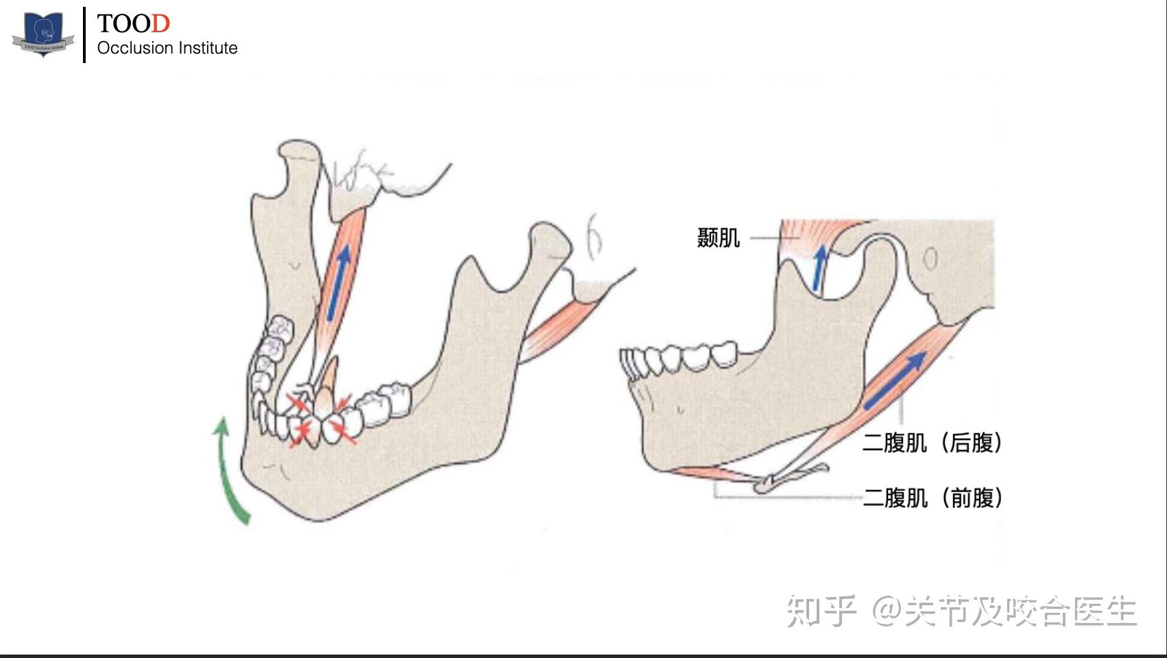 肌肉的潜在记忆是导致咬合早接触的原因之一,主要是与下颌二腹肌相关
