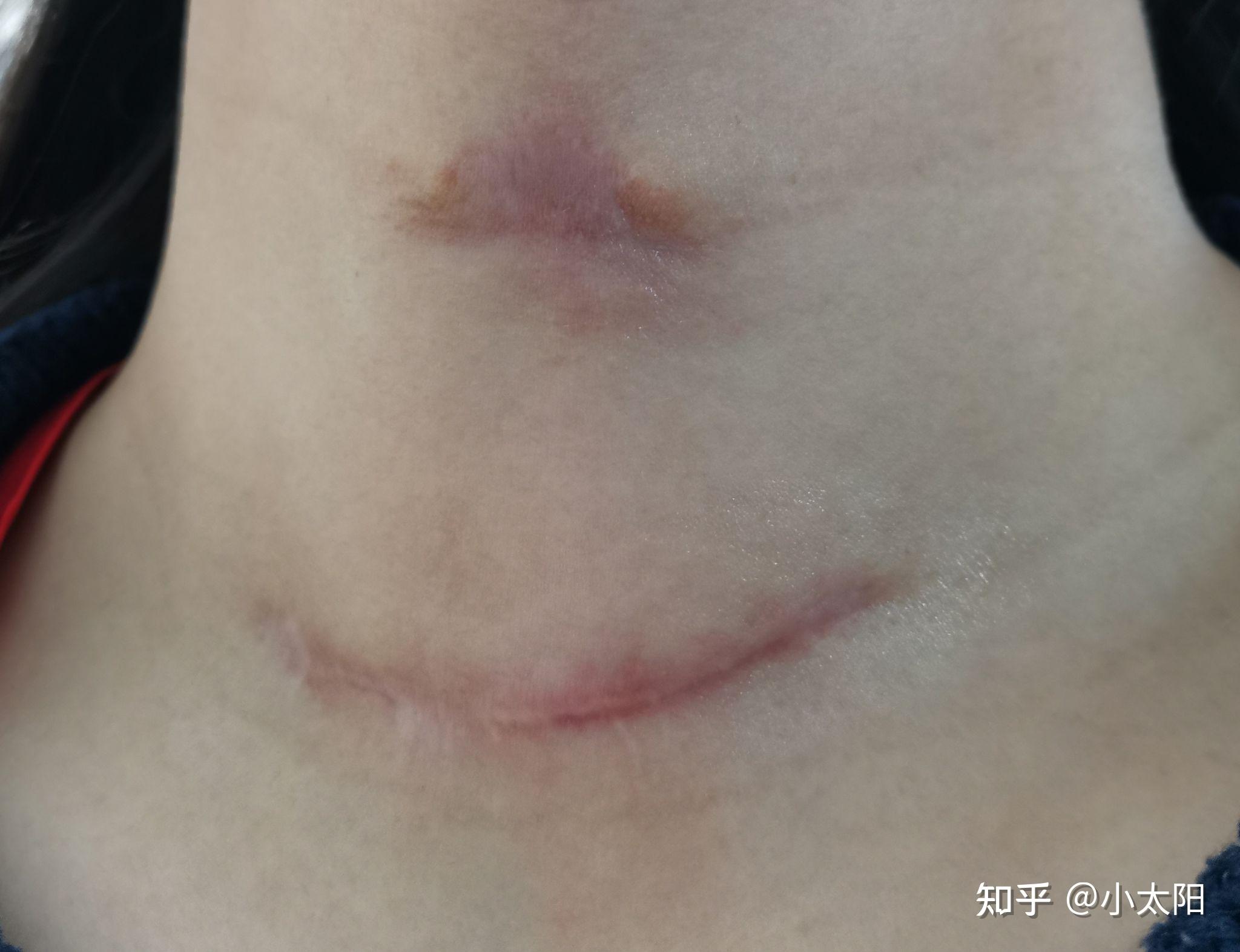 甲状腺乳头状癌左边半切疤痕恢复情况