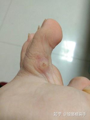 长了鸡眼怎么办 怎么去除 知乎