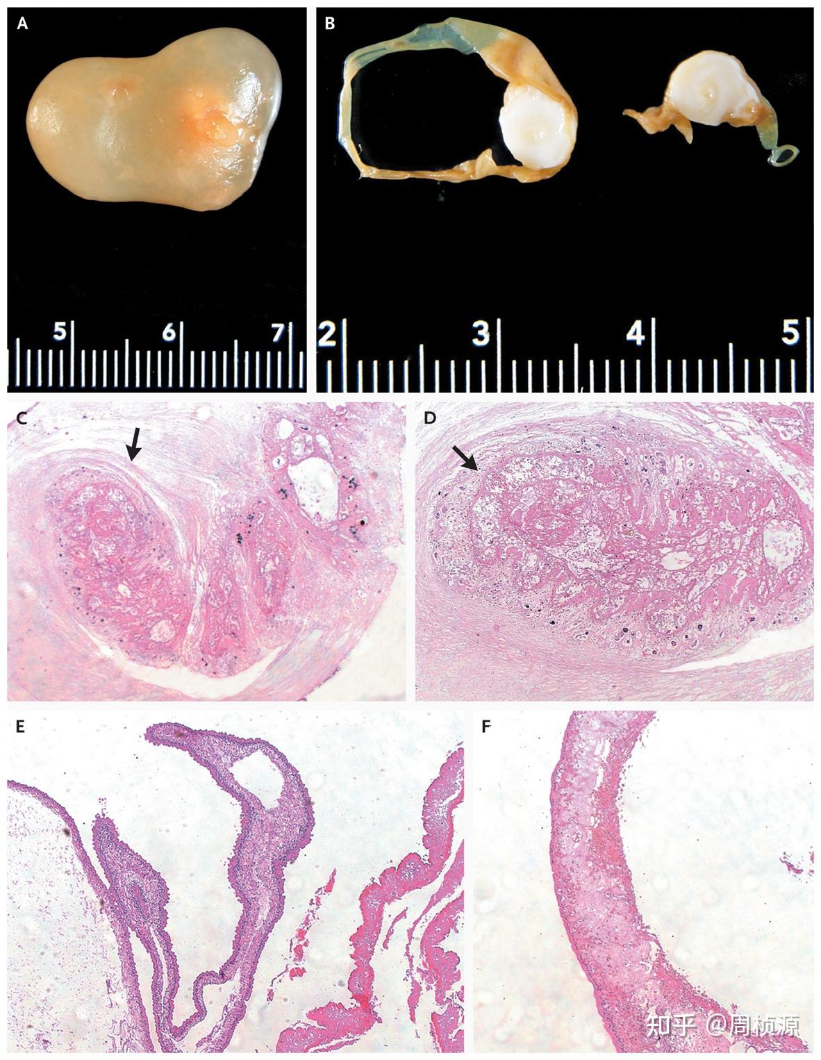 打开硬脑膜,可见黄色蛛网膜下腔.