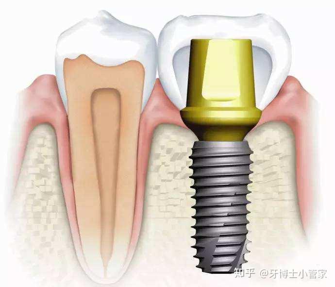 一,缺牙了怎麼修復?