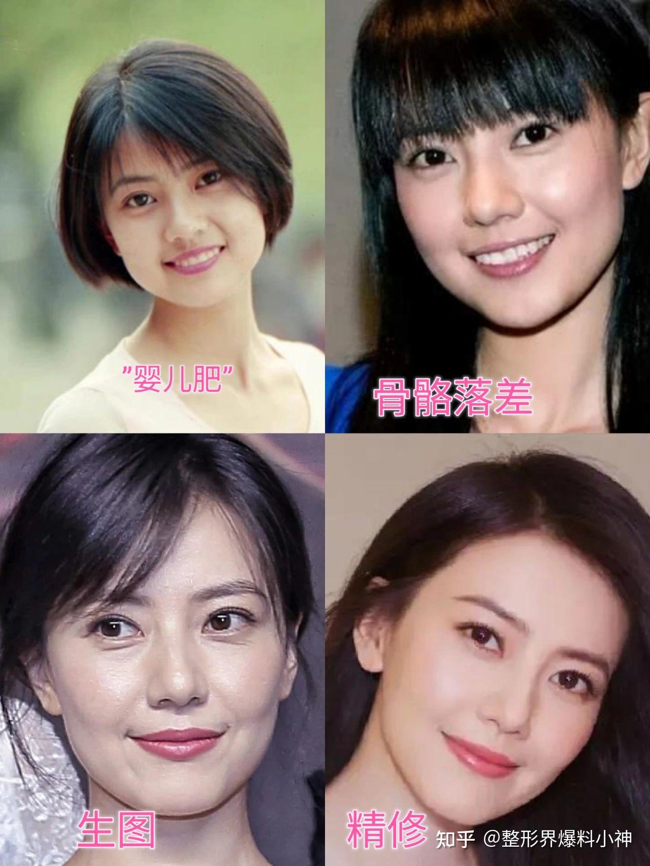吸腮/面部结构凹陷分析 - 知乎