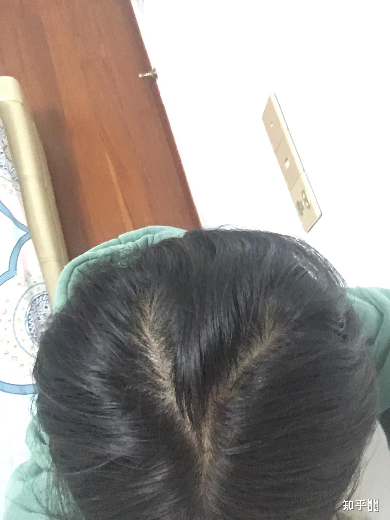 有头顶和我一样情况的吗本来后脑勺上有两个旋加上头发不多就像个字母