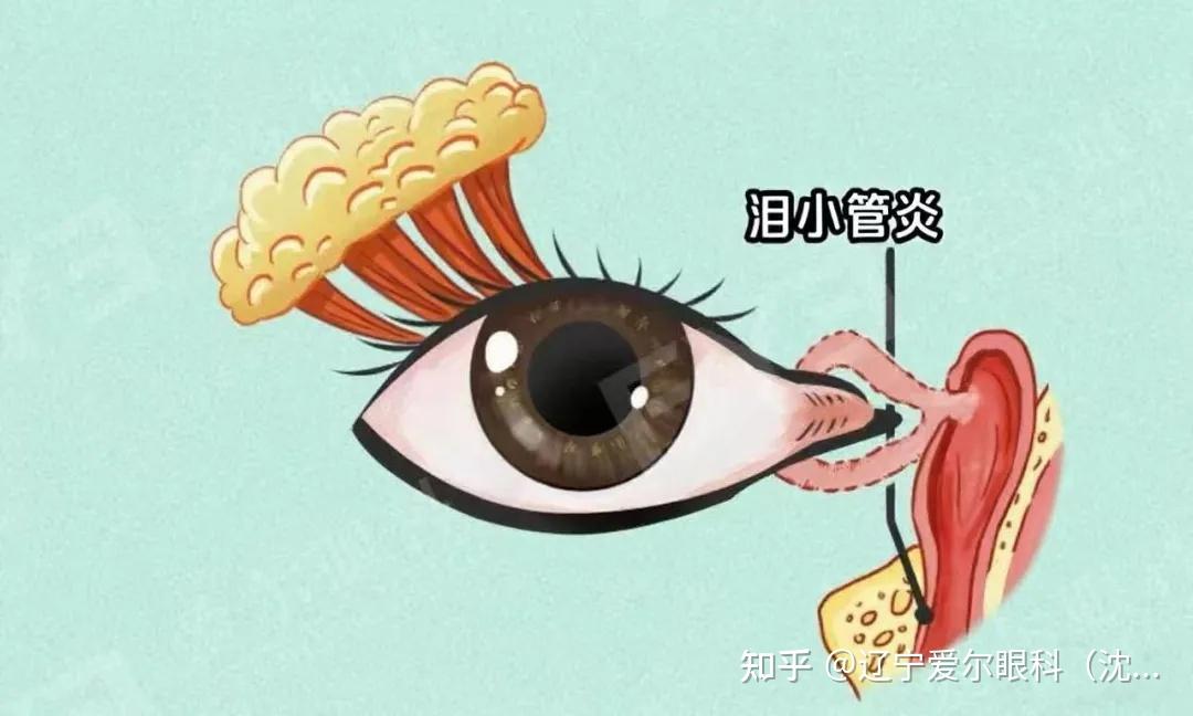 眼角痒、眼屎多,警惕这种“隐形炎症”——泪小管炎 - 知乎