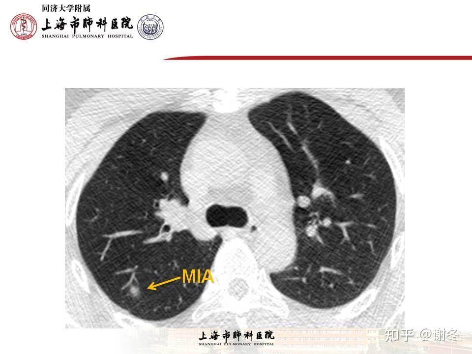 元芳,你看,mia是非常早期的非小細胞肺癌,mia的定義是指病灶≤3 cm