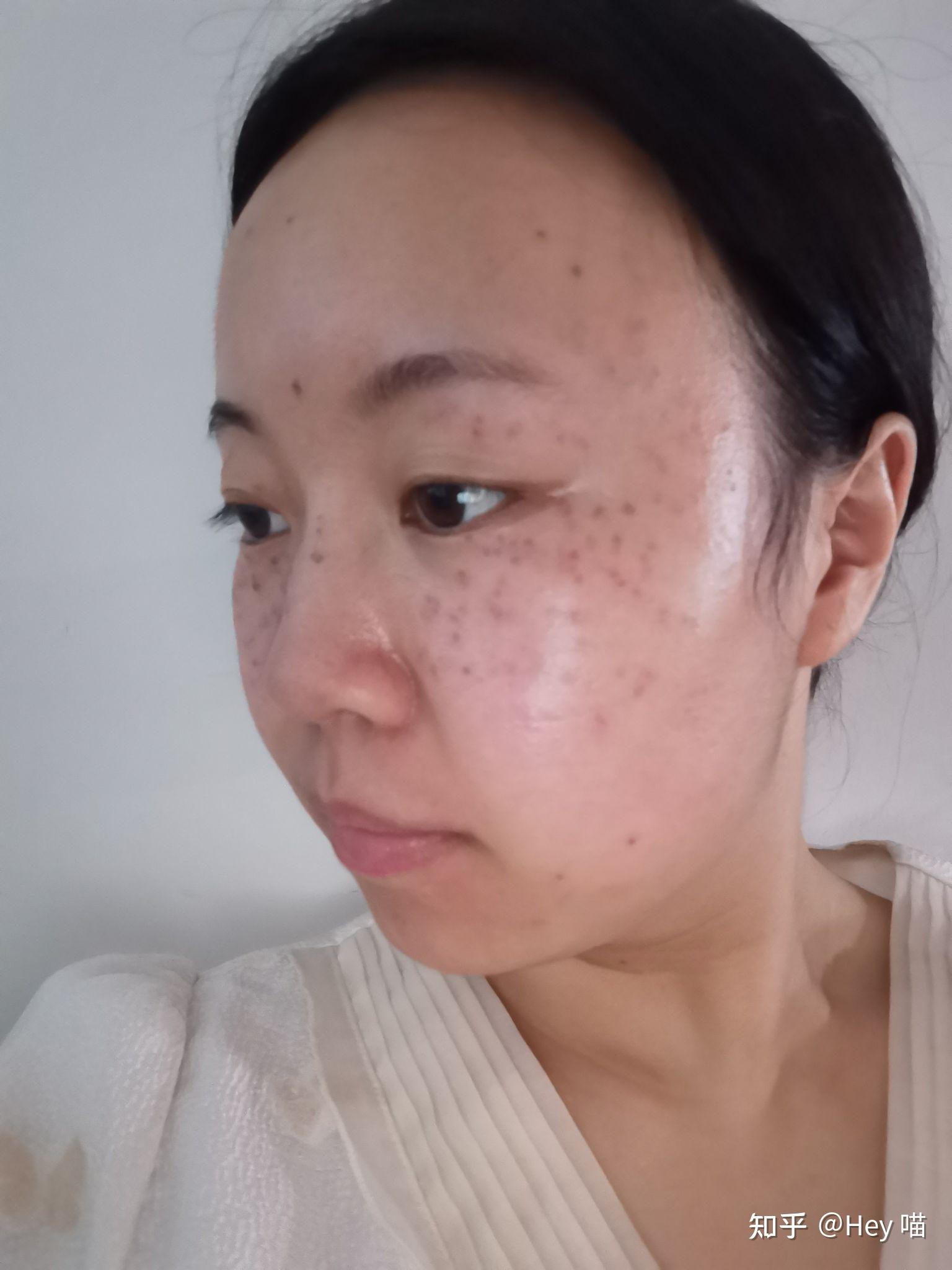 激光祛斑的经历