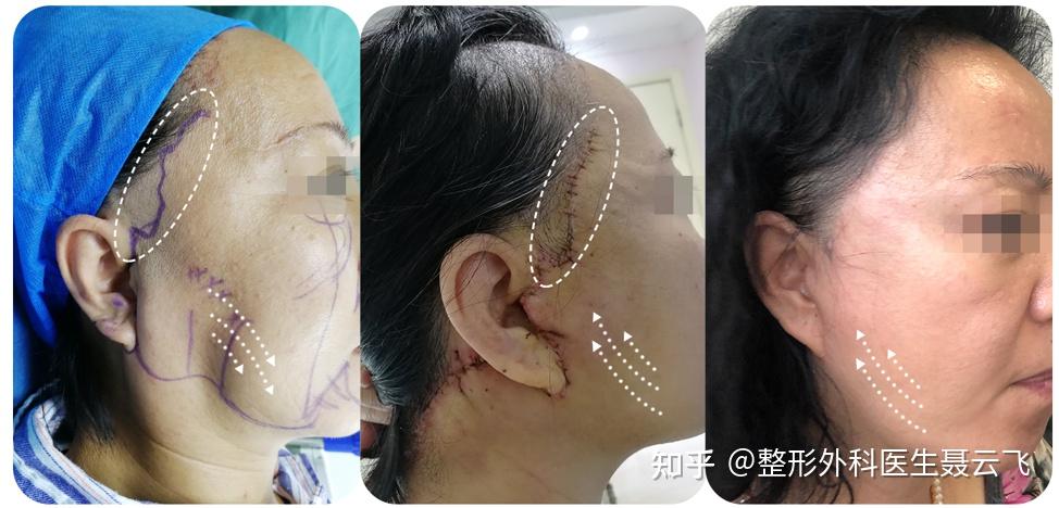 皮,恢复后切口痕迹基本看不见中下面部拉皮手术的切口就相对比较大了