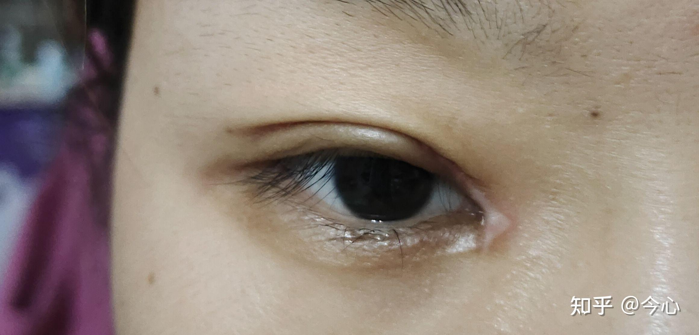 眼角疤痕增生初期图片图片