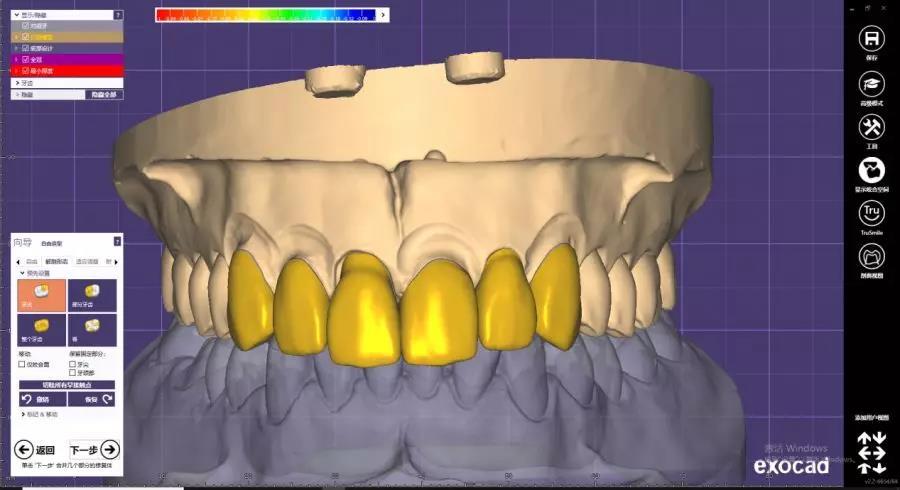 絢彩3d前牙全形態冠怎麼設計絢彩3d前牙全形態冠設計五步法