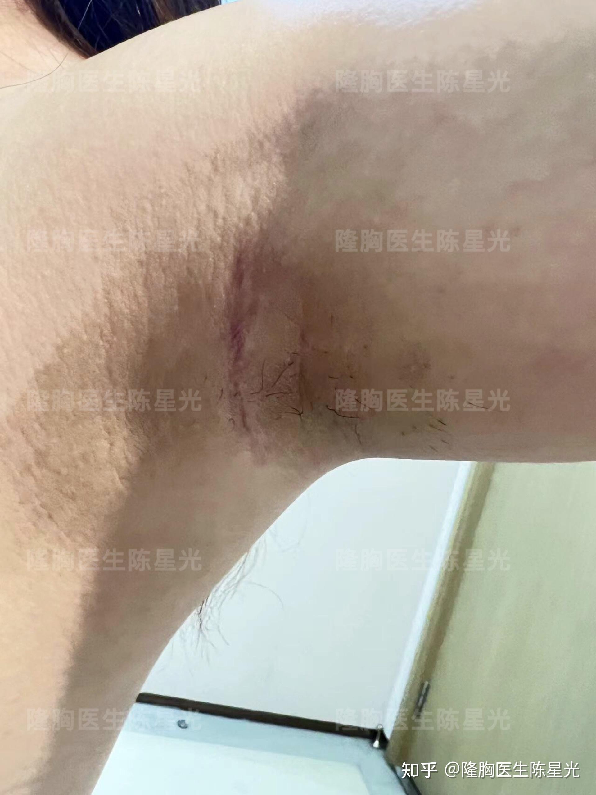 假体隆胸腋下切口术后2个月疤痕是怎样的?