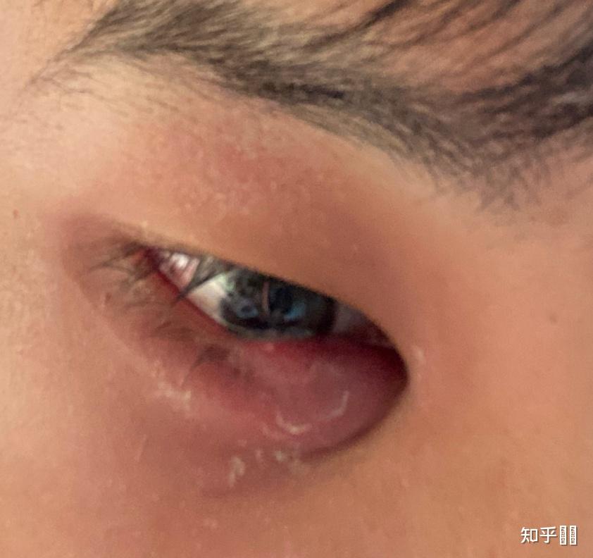 生了撅眼怎么办? - 知乎
