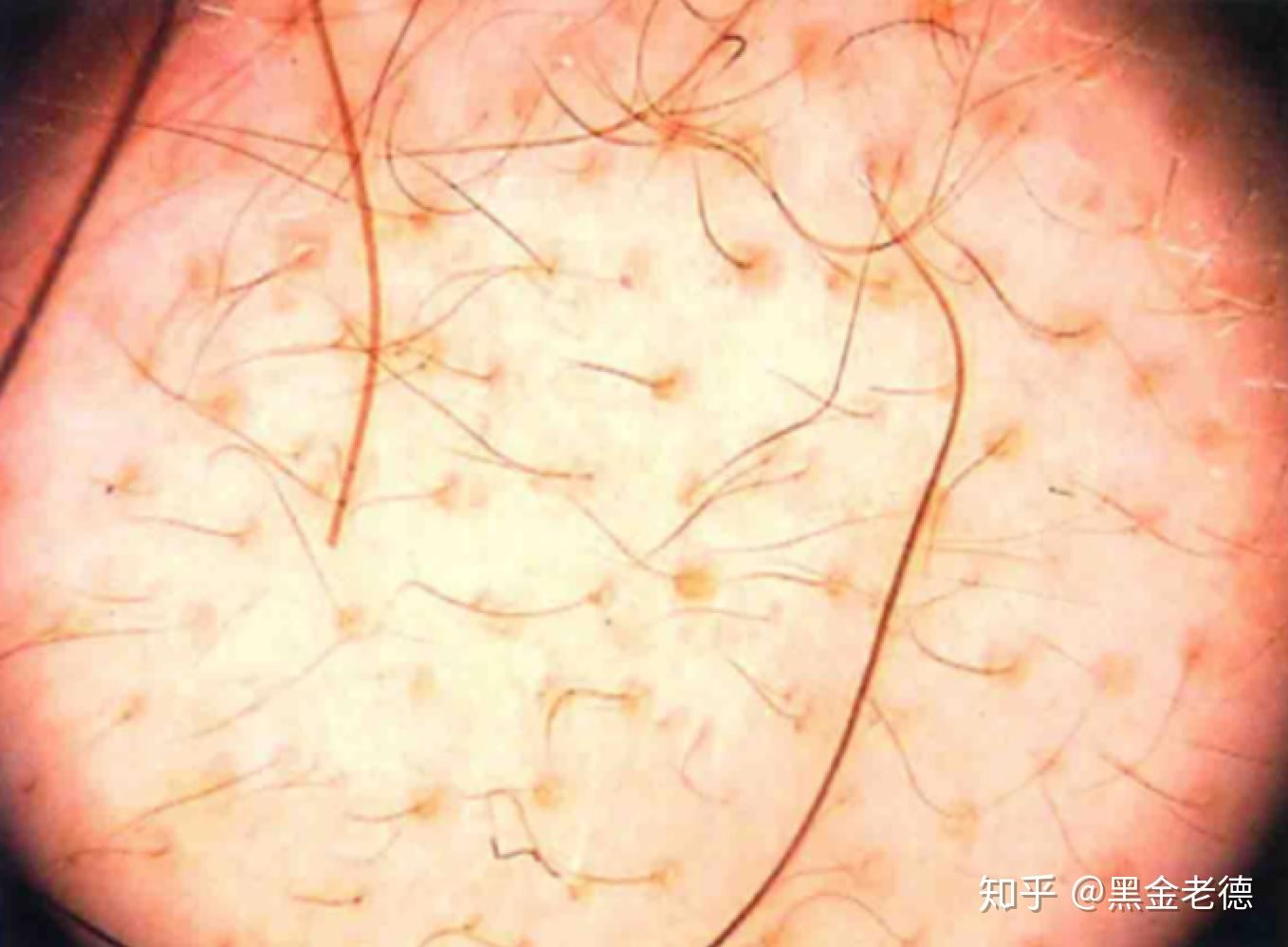 头发逐渐退化成寒毛