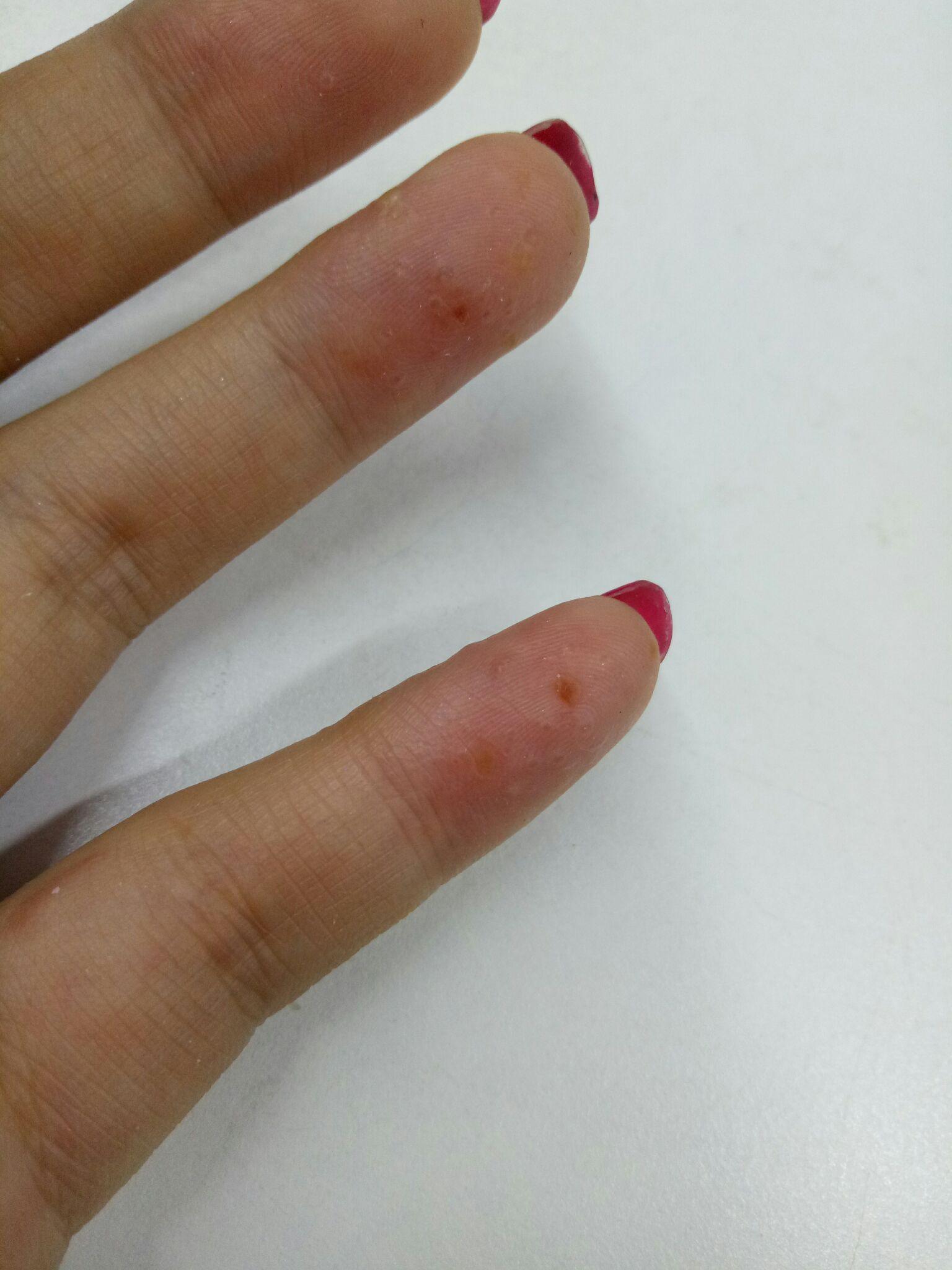 长类似水泡但比水泡小很多的泡泡微微有点痒然后会蜕皮这是怎么回事呀