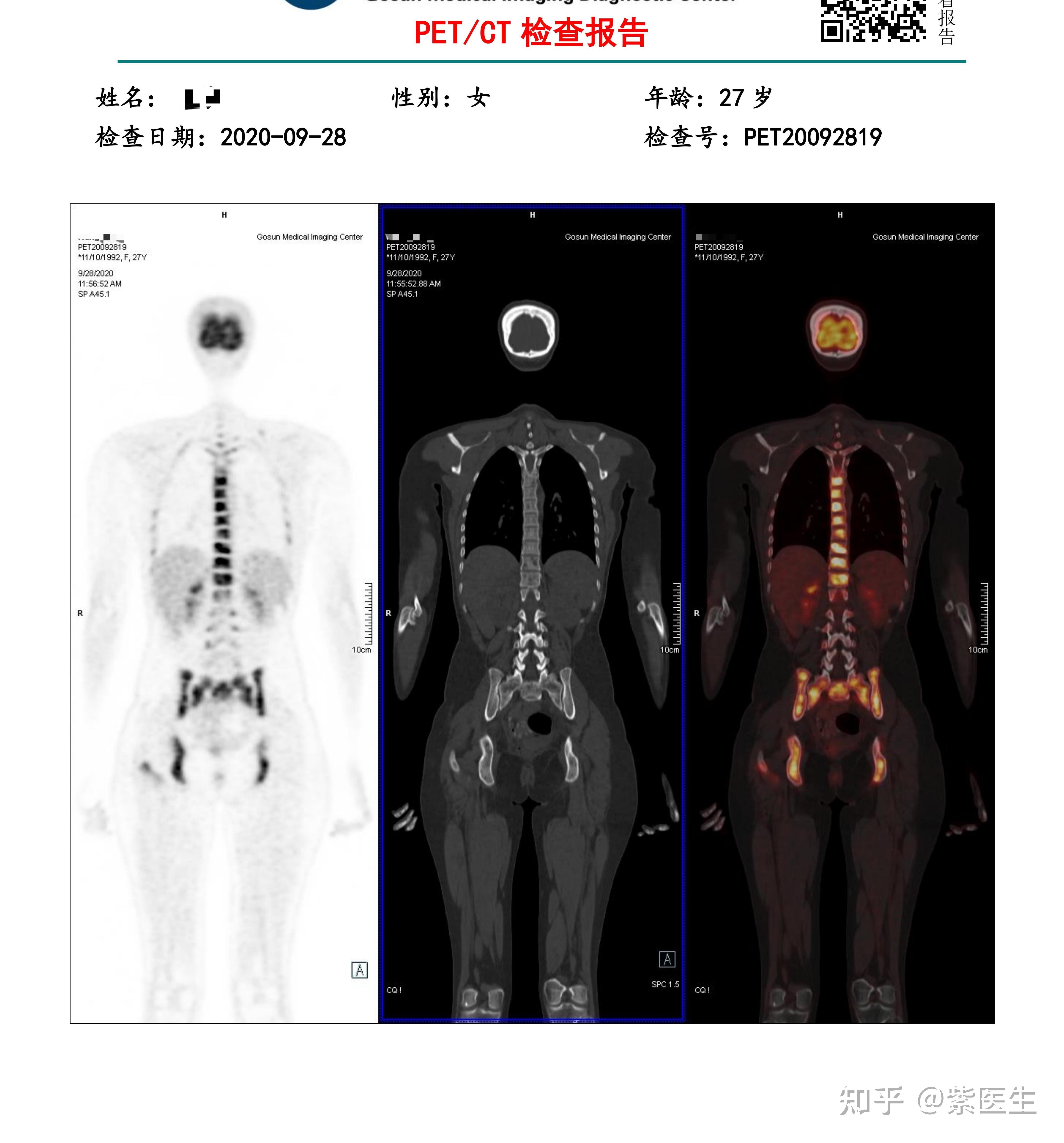 年轻女孩手脚淤青，PET/CT诊断为胃癌伴全身转移 - 知乎