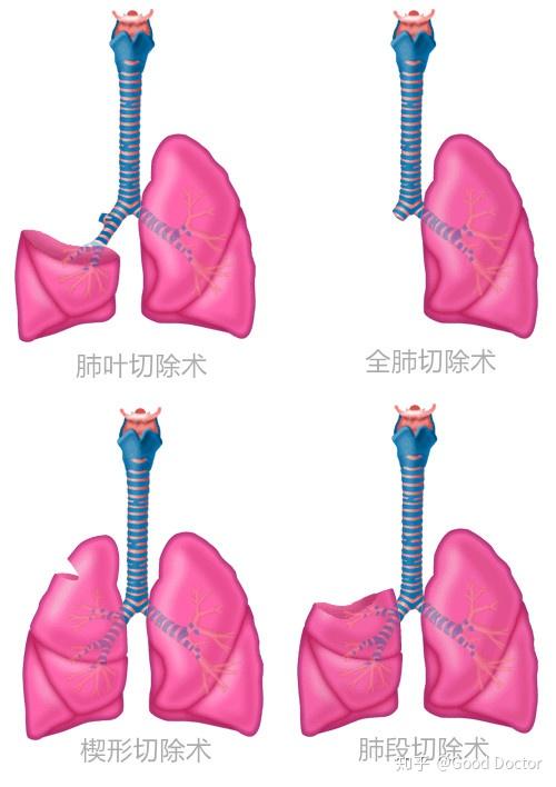 肺癌术后走路喘气费劲?呼吸操帮你解决问题! - 知乎