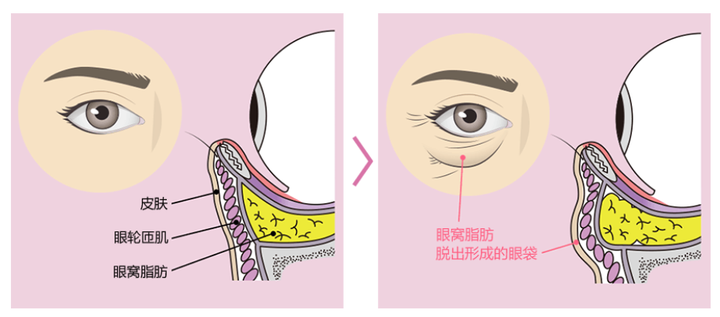 眼袋的成因及构成
