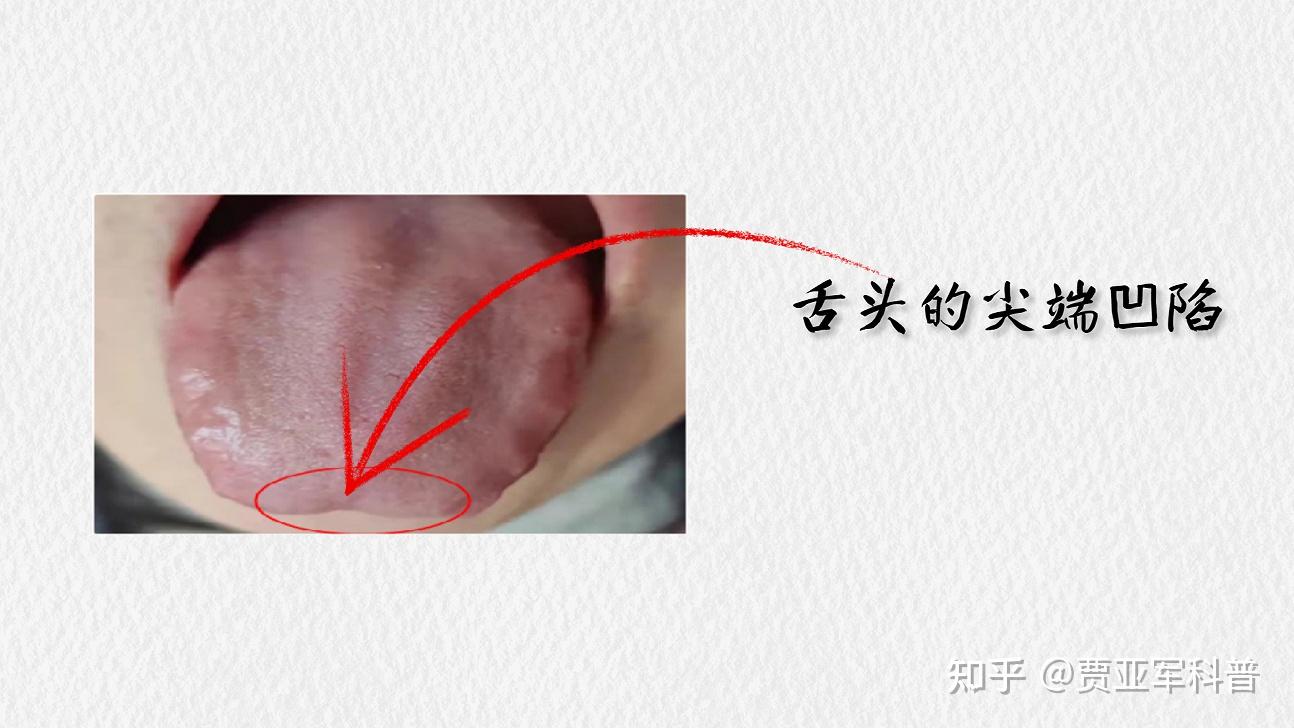 气虚怎么补?舌象告诉你答案,医生教你如何正确调理五脏气虚 - 知乎