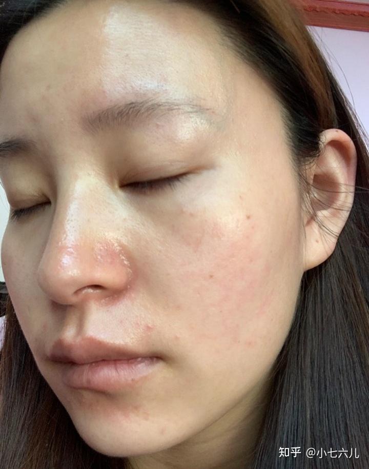 角质层受损真的是不治之症吗?多久才能完全修复好呢? - 知乎