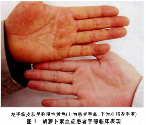 吃南瓜皮肤真的要变黄吗? - 知乎