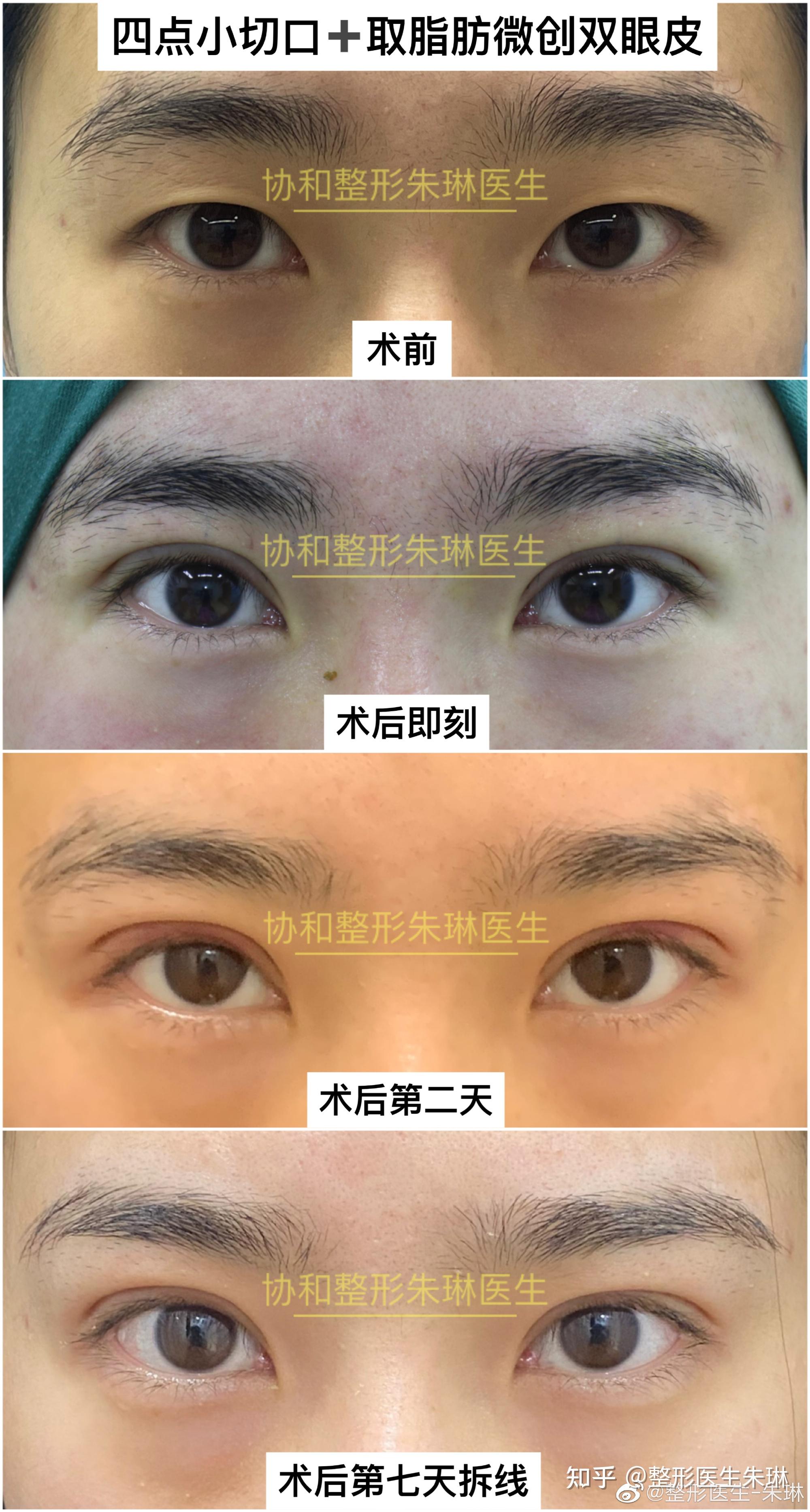 王太玲医生三点微创双眼皮案例分享-1-5 - 好大夫在线
